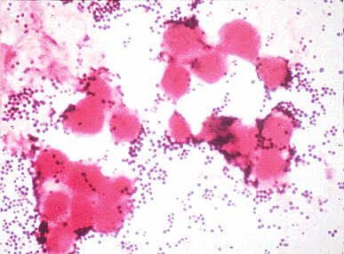 Gram stain of Staphylococcus aureus in pustular exudate.
