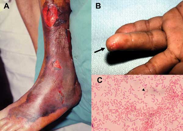A. Characteristic skin lesions associated with Vibrio 